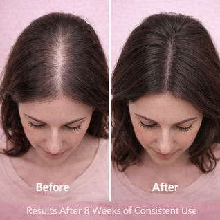 GlowPro Red Light Therapy Scalp Massager for Hair Growth